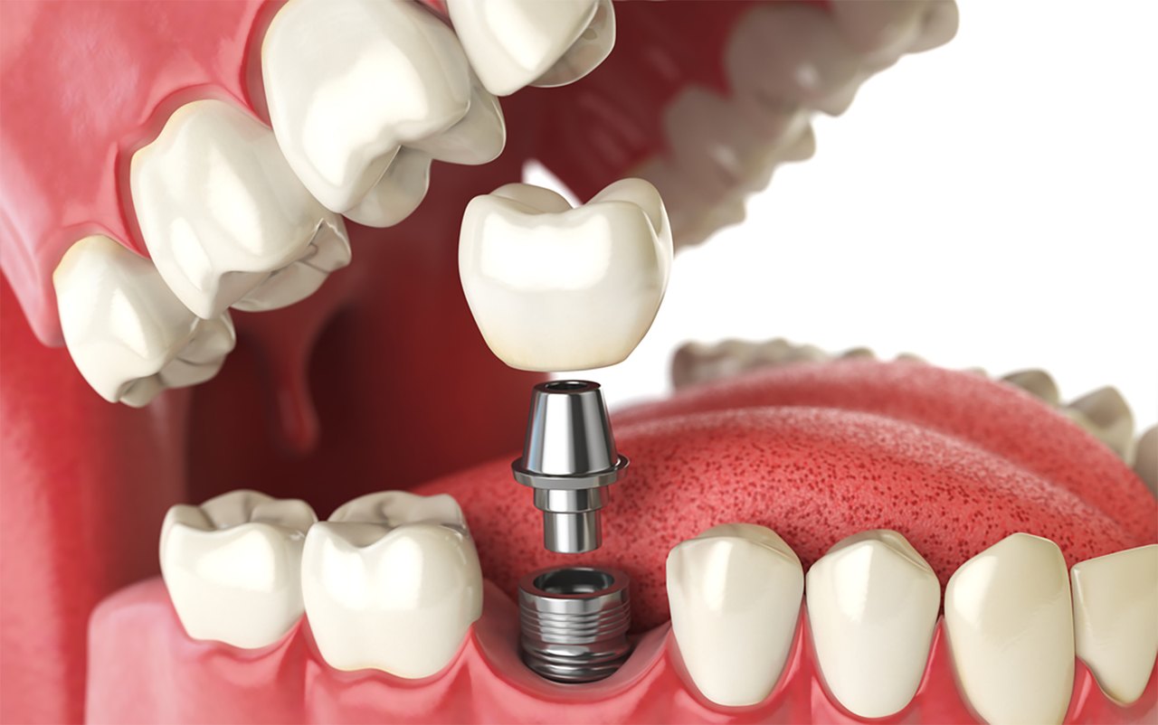 Implantes Dentários na OdontoCompany Jaçanã